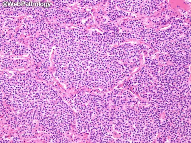 These are a form of thymus neuroendocrine cancer cells. 