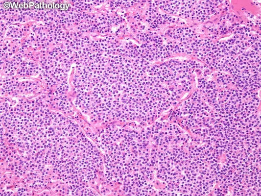 These are a form of thymus neuroendocrine cancer cells. 